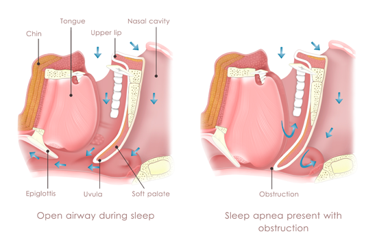 sleep-apnea-treatment-lebanon-nh-upper-valley-nh