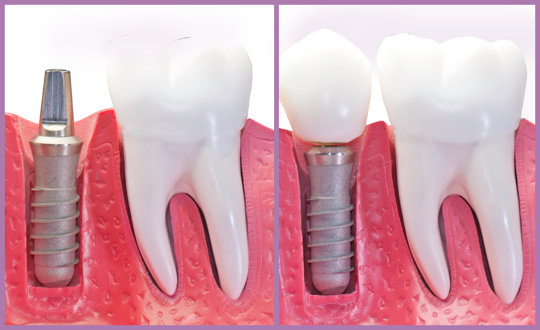 dental-implants-lebanon-nh-upper-valley-nh-dentist