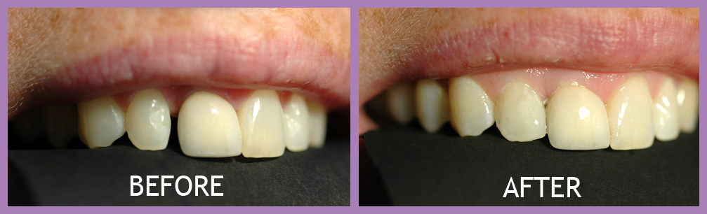 invisalign-before-and-after-images