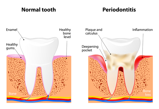 periodontal-disease-specialist-dentist-lebanon-nh-upper-valley