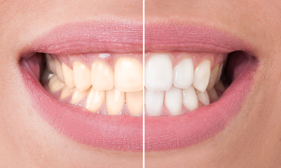 teeth-whitening-lebanon-nh-upper-valley